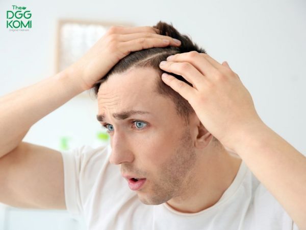 Nguyên nhân tóc rụng nhiều ở nam giới